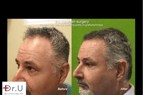 Patient Results Gallery, Dr U Hair Clinic Los Angeles