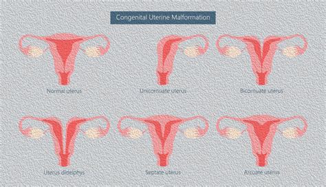 Bicornuate Uterus - Dr Eleftherios Meridis