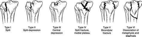 Schatzker Fracture Classification