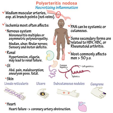 Pathology Glossary: Vasculitis - Medium and Variable Vessel Sizes ...