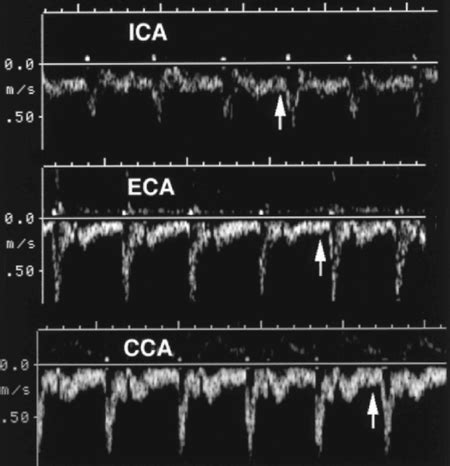 Normal Doppler Spectra of the carotid arteries. This links to a really long but really ...