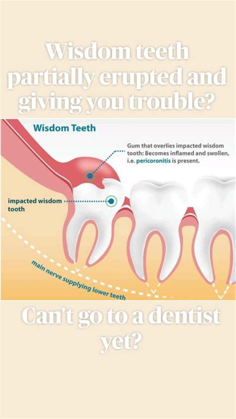 How Long To Apply Heat After Wisdom Teeth at Shane Leslie blog