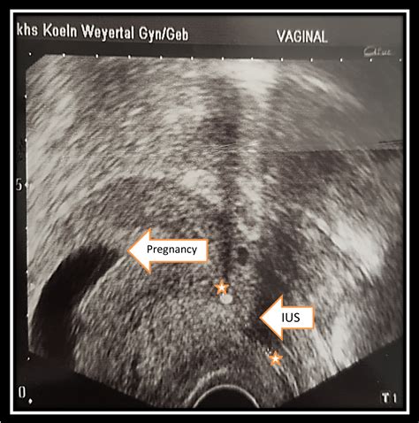 Case Report: Pregnancy While Using an IUD