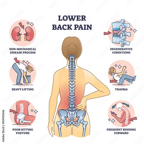 Lower back pain and painful body backbone skeleton causes outline diagram, VectorMine Foto ...