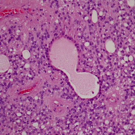 Ependymoma (histology) | Radiology Case | Radiopaedia.org