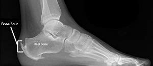 Heel Spurs - ACCESS PT - Physical Therapy