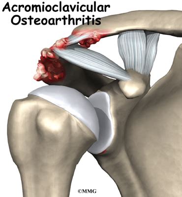 Osteoarthritis of the Acromioclavicular Joint | Orthogate