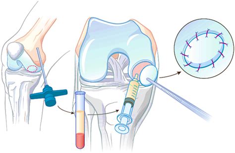 Matrix-Associated Chondroplasty: A Novel Platelet-Rich Plasma and Concentrated Nucleated Bone ...