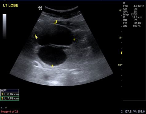 Simple hepatic cyst rupture exacerbated by anticoagulation | BMJ Case Reports