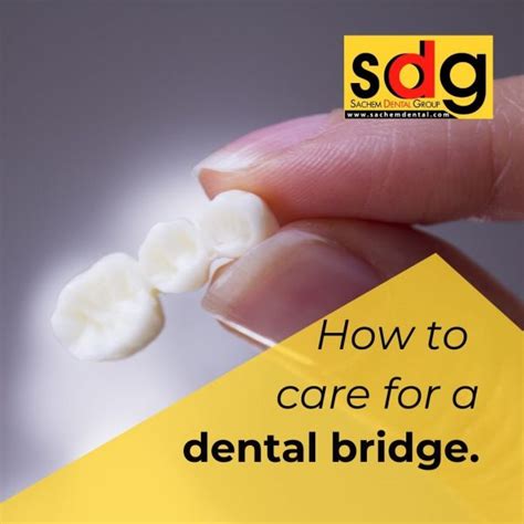 How To Care For My Dental Bridge - Sachem Dental Group