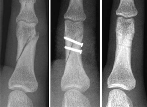 case 1: a simple oblique fracture of the proximal phalanx in the left ...