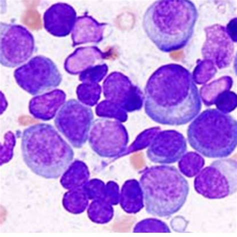 Diseases of Lymphnodes and Plasma Cells | Pathology Made Simple