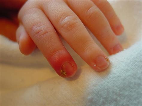 Nails infection in children | DoktorBudak.com