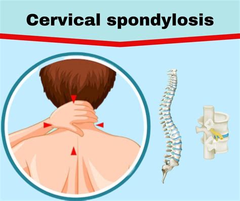 21 Cervical Spondylosis Ideas Cervical Spondylosis Ce - vrogue.co