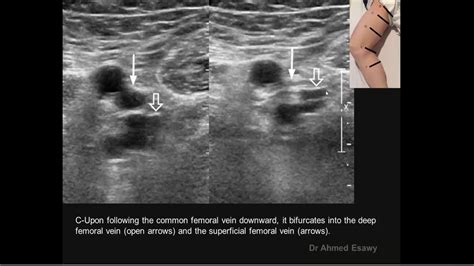 COMPRESSION ULTRASOUND DVT Dr Ahmed Esawy - YouTube