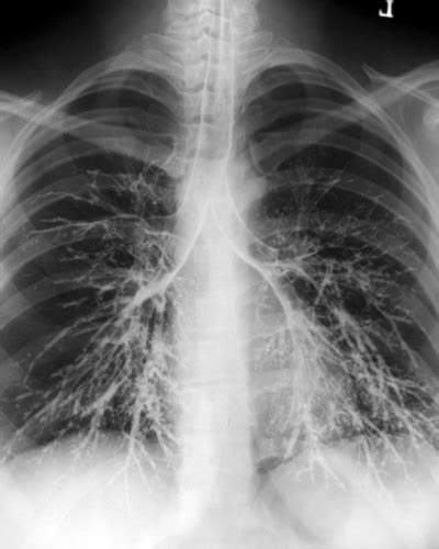 Air Bronchogram Chest X Ray | SexiezPicz Web Porn