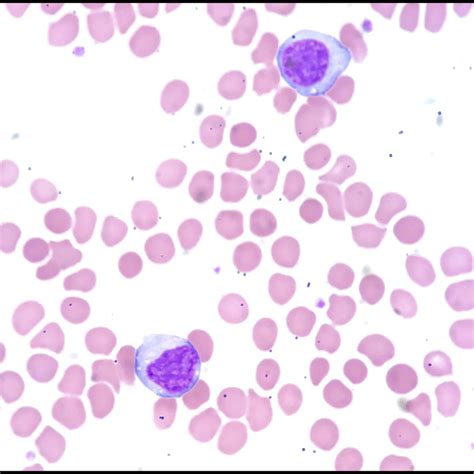 Mononucleosis - Acute Infectious Mononucleosis Pathogenesis And Clinical Findings Calgary Guide ...