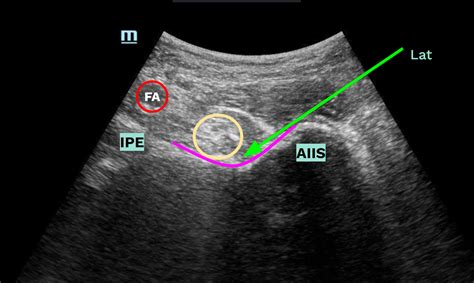 ultrasound PENG block model – Sinai EM