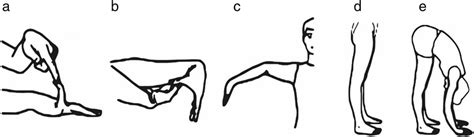 Beighton scoring system measures joint hypermobility on a 9-point... | Download Scientific Diagram