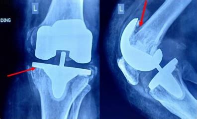 Revision Knee Replacement - Spine & Joint Clinic