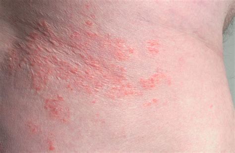 Inverse psoriasis vs. intertrigo: Symptoms, causes, and identification