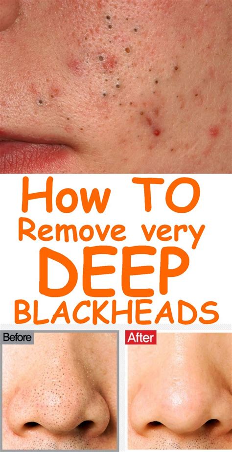 How Are Blackheads Formed - Blackheads Removal | New Pimple Popping ...