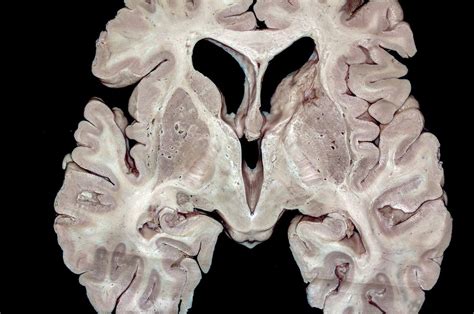 Axial Section of the Brain at the Level of the Foramina of Monro ...