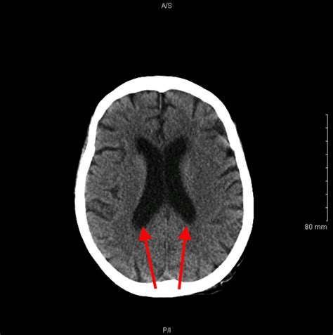 Radiological Anatomy: Lateral Ventricles (The Brain) - Stepwards