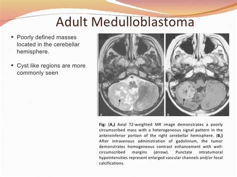 Diagnosis, Treatment & Management of Medulloblastoma