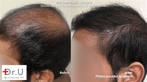 Dr Umar Hair Transplant Reviews Los Angeles | HairSite.com