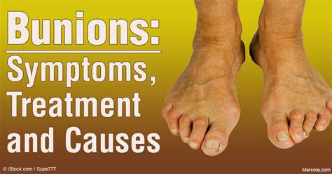 Bunions: Causes, Symptoms and Treatment