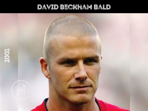 David Beckham Hair Transplant - Hair Loss & Technical Analysis