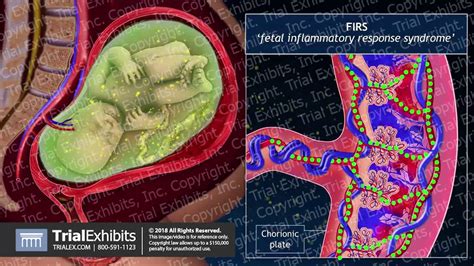 Progression of Chorioamnionitis and its Effects on the Fetal Brain ...