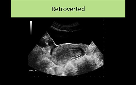 Retroverted Uterus ultrasound | Sonography, Ultrasound, Medical ultrasound