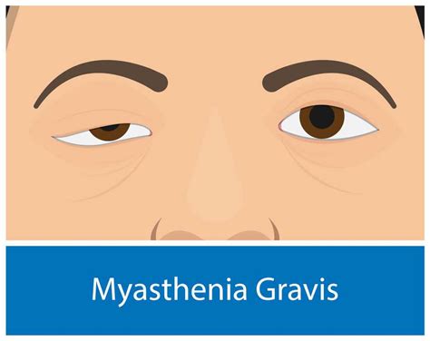 Myasthenia Gravis; Symptoms, Causes & Treatment - Page 2 of 10 - A2Z Healthy