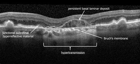 Consensus Definition for Atrophy Associated with Age-Related Macular ...