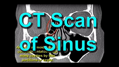 Infected Sinus Ct Scan