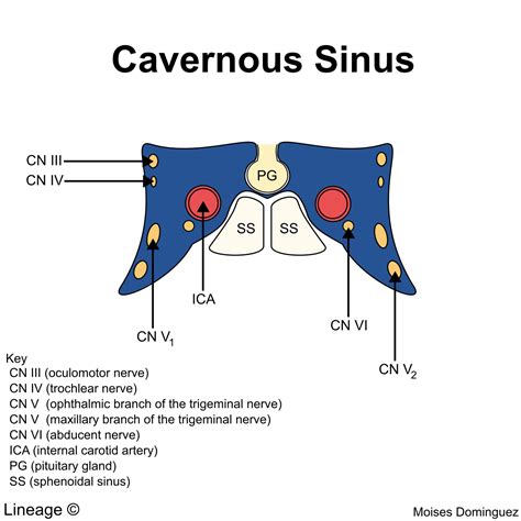 Cavernous Sinus Thrombosis - Neurology - Medbullets Step 2/3