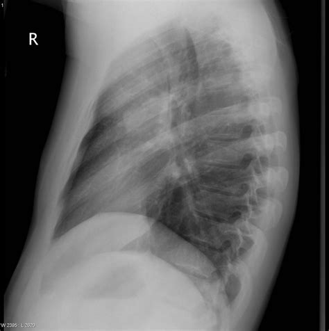 Hodgkin's lymphoma x ray findings - wikidoc