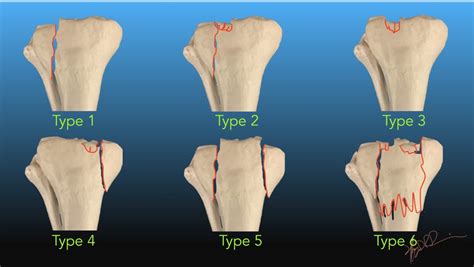 Occult tibial plateau fracture - Dergalaxy