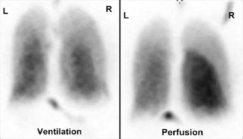 Pulmonary Embolism – Diagnosis & Treatment – Page 3 – New Life Ticket