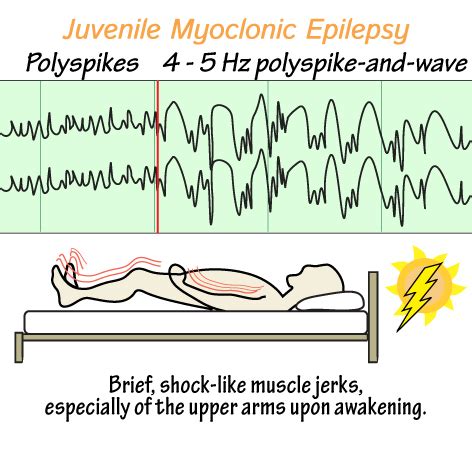 Neurological System Glossary: Juvenile Myoclonic Epilepsy (JME) | Draw ...