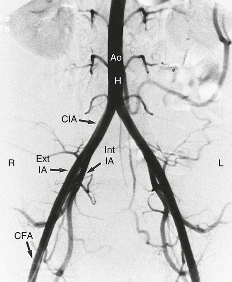 Vascular Anatomy of the Pelvis | Radiology Key