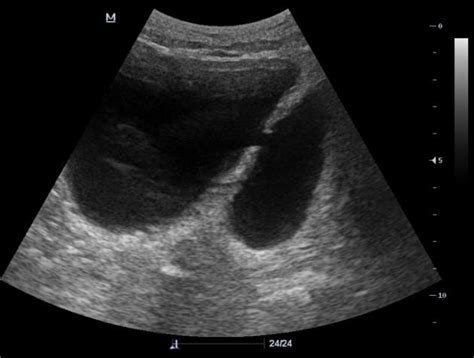 Bladder diverticulum | Radiology Case | Radiopaedia.org | Radiology, Bladder, Basic anatomy and ...