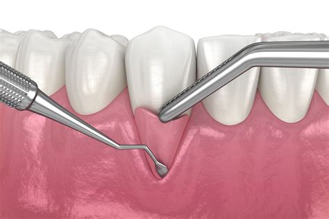 Gum Grafting Choices: Autograft vs Allograft - London Dental Specialists