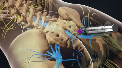 Lumbar caudal epidural steroid injection Southlake, Texas – South Lake ...