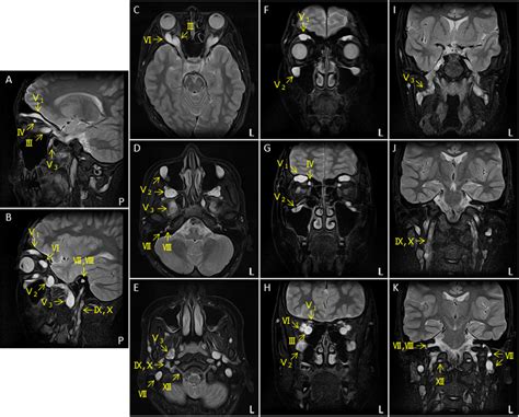 Cranial Nerves Axial Mri