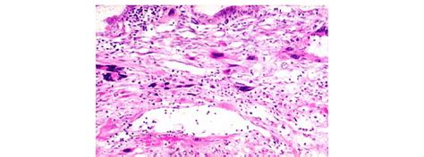 Syncytiotrophoblasts embeded in postmolar endometrium may cause... | Download Scientific Diagram