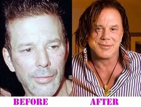 Mickey Rourke Plastic Surgery - With Before And After Photos