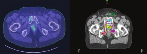 PET imaging. (left) PET scan image of recurrent disease in a... | Download Scientific Diagram